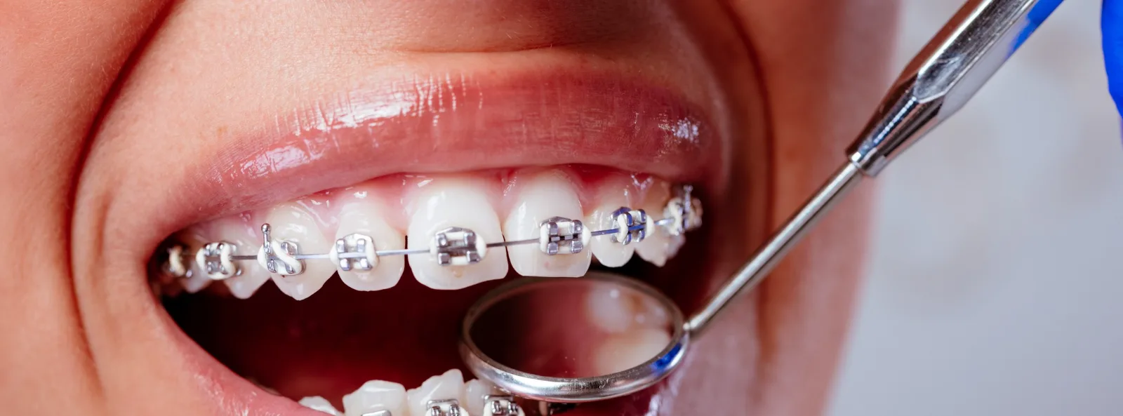 Paciente con brackets sonriendo